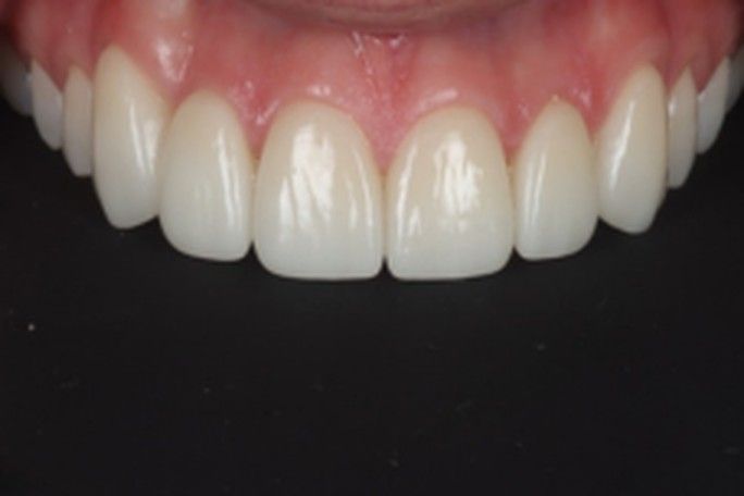 After — finished porcelain veneers