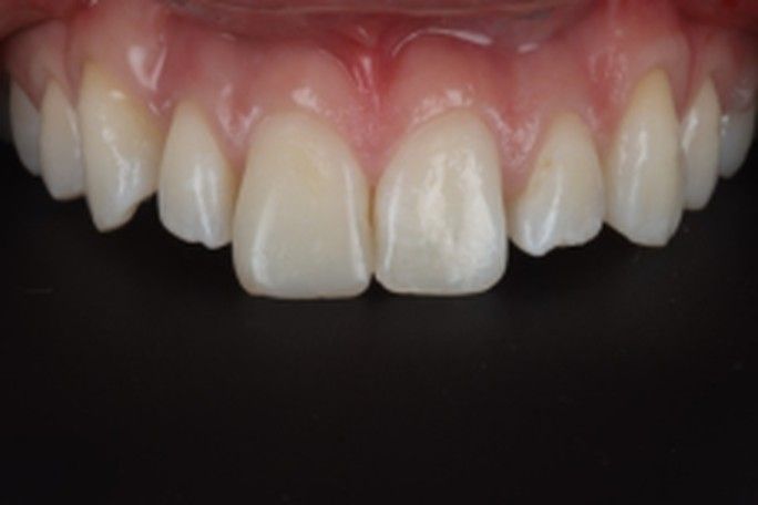 Before — natural worn teeth
