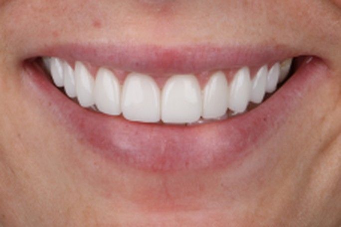 After — finished porcelain veneers