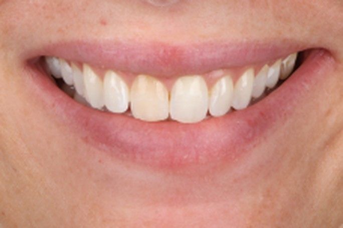 Before — natural smile