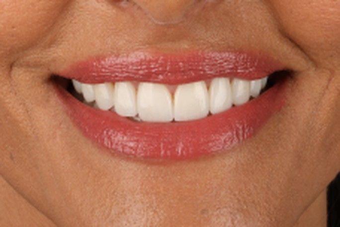 After — finished porcelain veneers