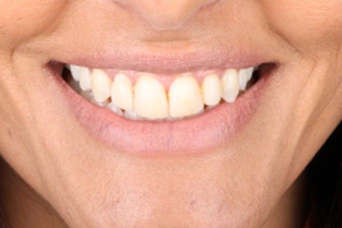 Before — natural worn teeth
