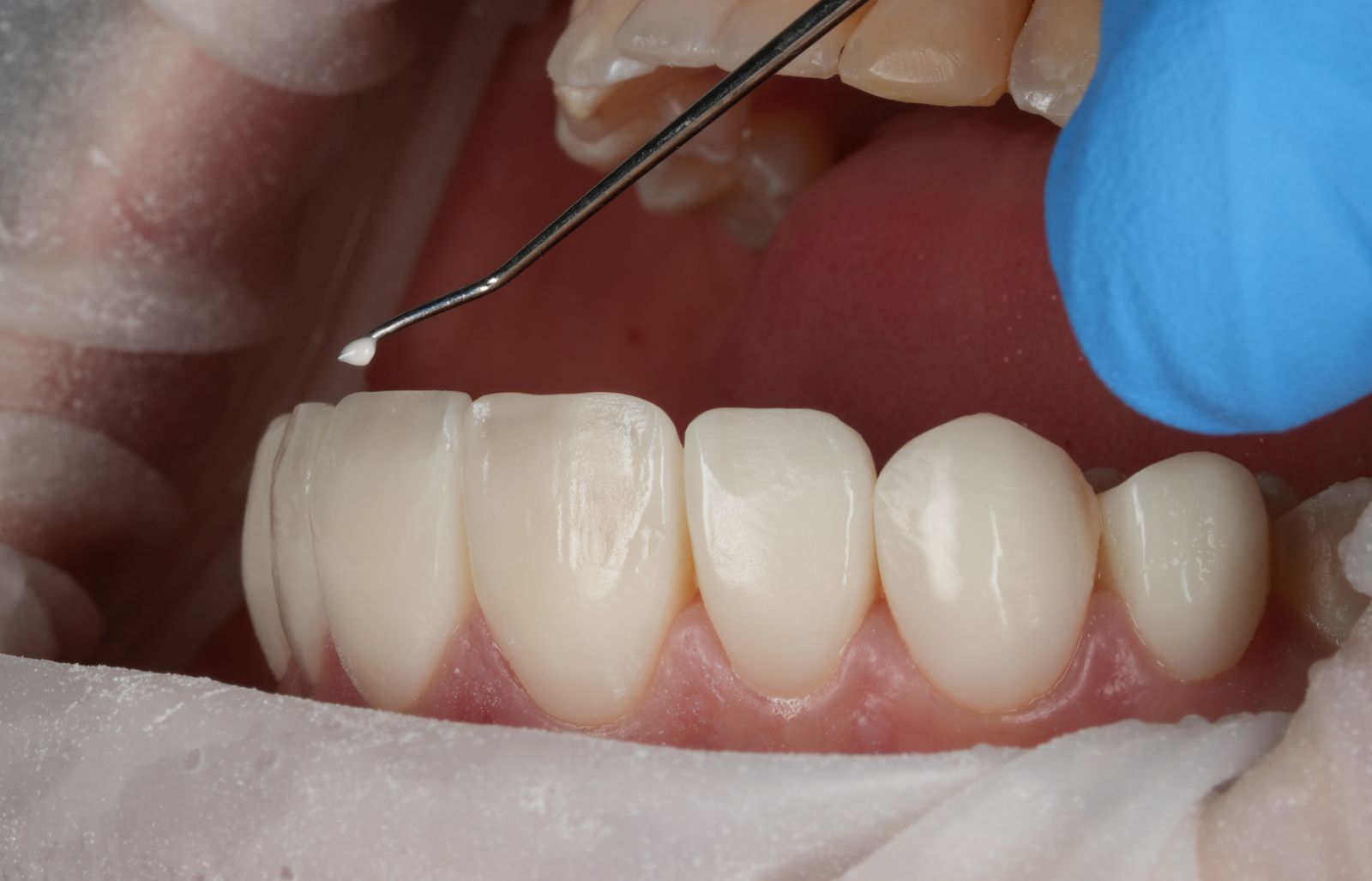Composite veneer layering