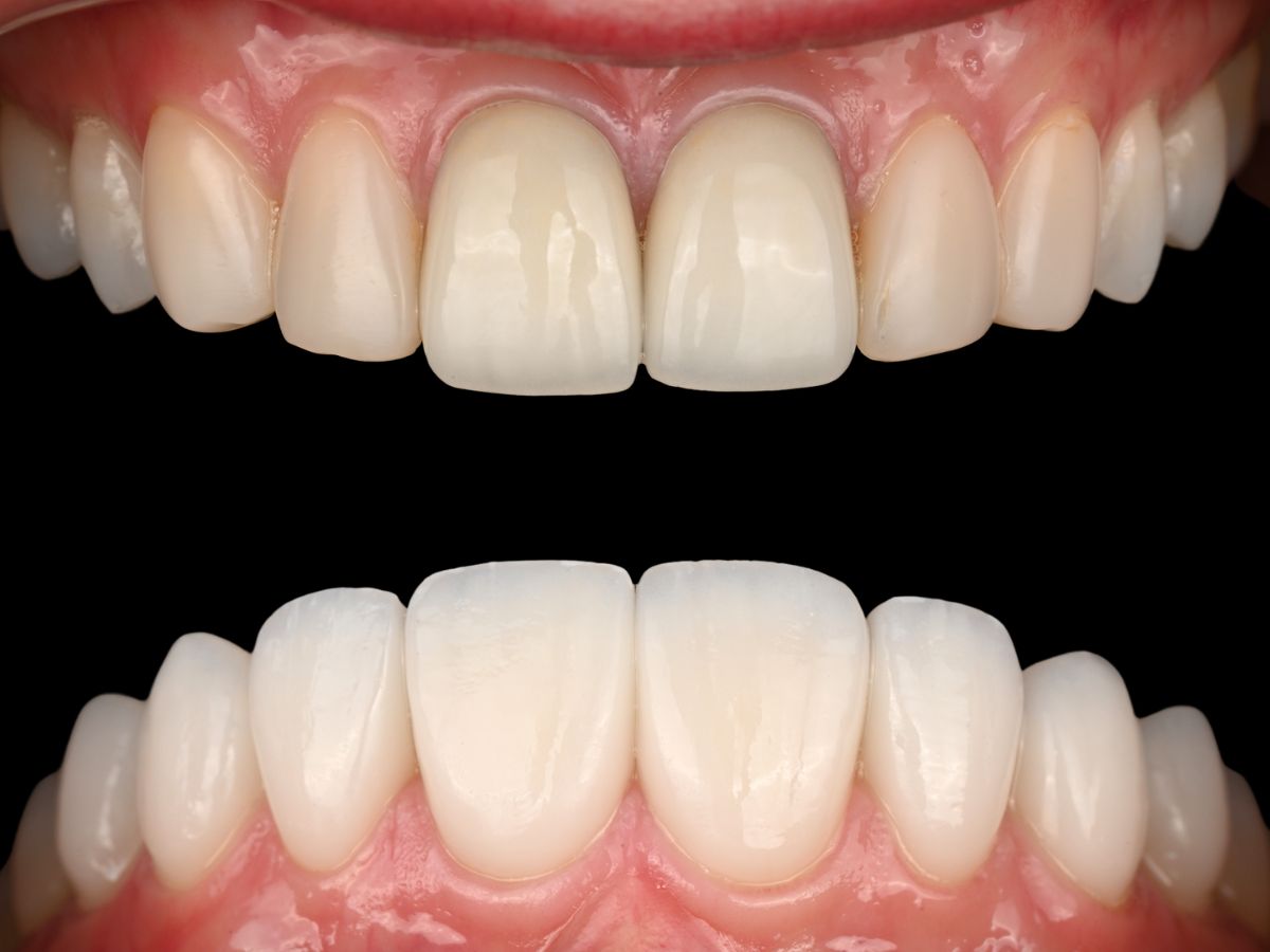 Before-and-after retracted view of finished porcelain veneer case
