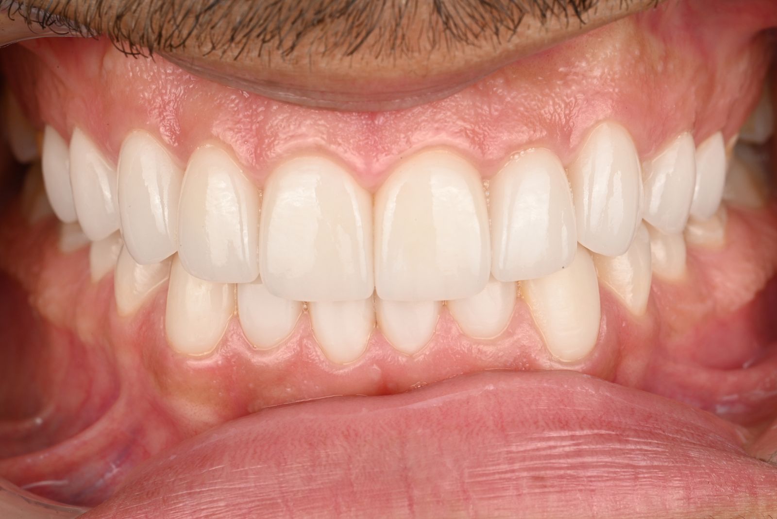 Retracted intraoral view, finished full-arch case