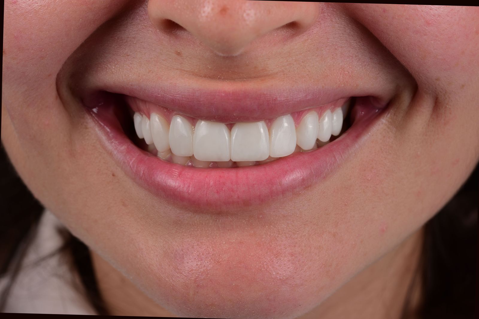 Finished smile, anterior view