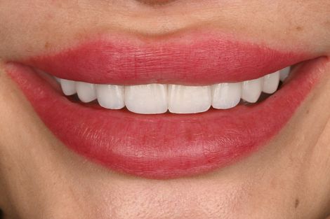 Porcelain veneer case