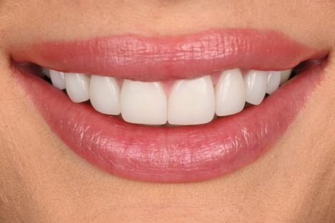 Porcelain veneer case
