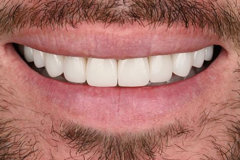 Porcelain veneer case