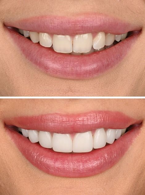 Before-and-after porcelain veneer rehabilitation case by Dr. Aodhan Docherty