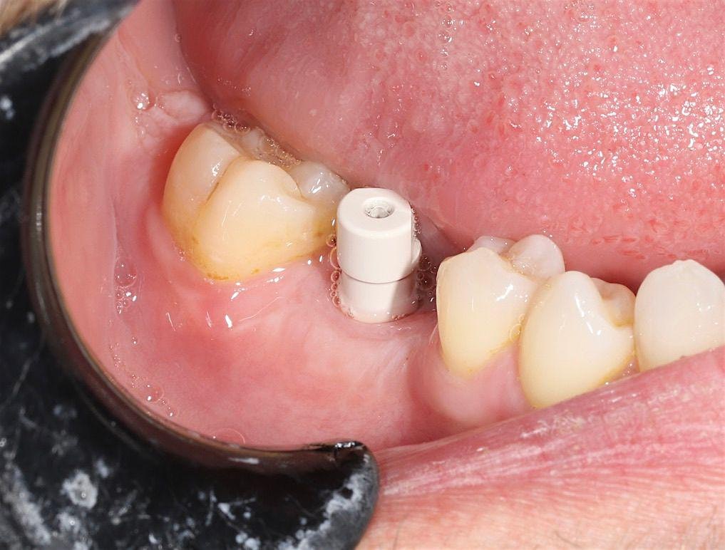 Healing abutment in place on a single posterior implant