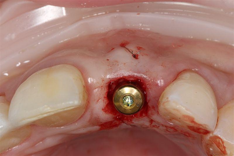 Single dental implant placed at surgery