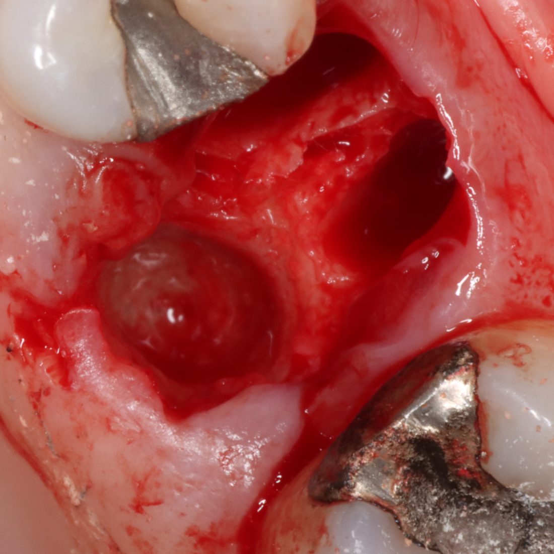 Bone removed around a root during a surgical extraction