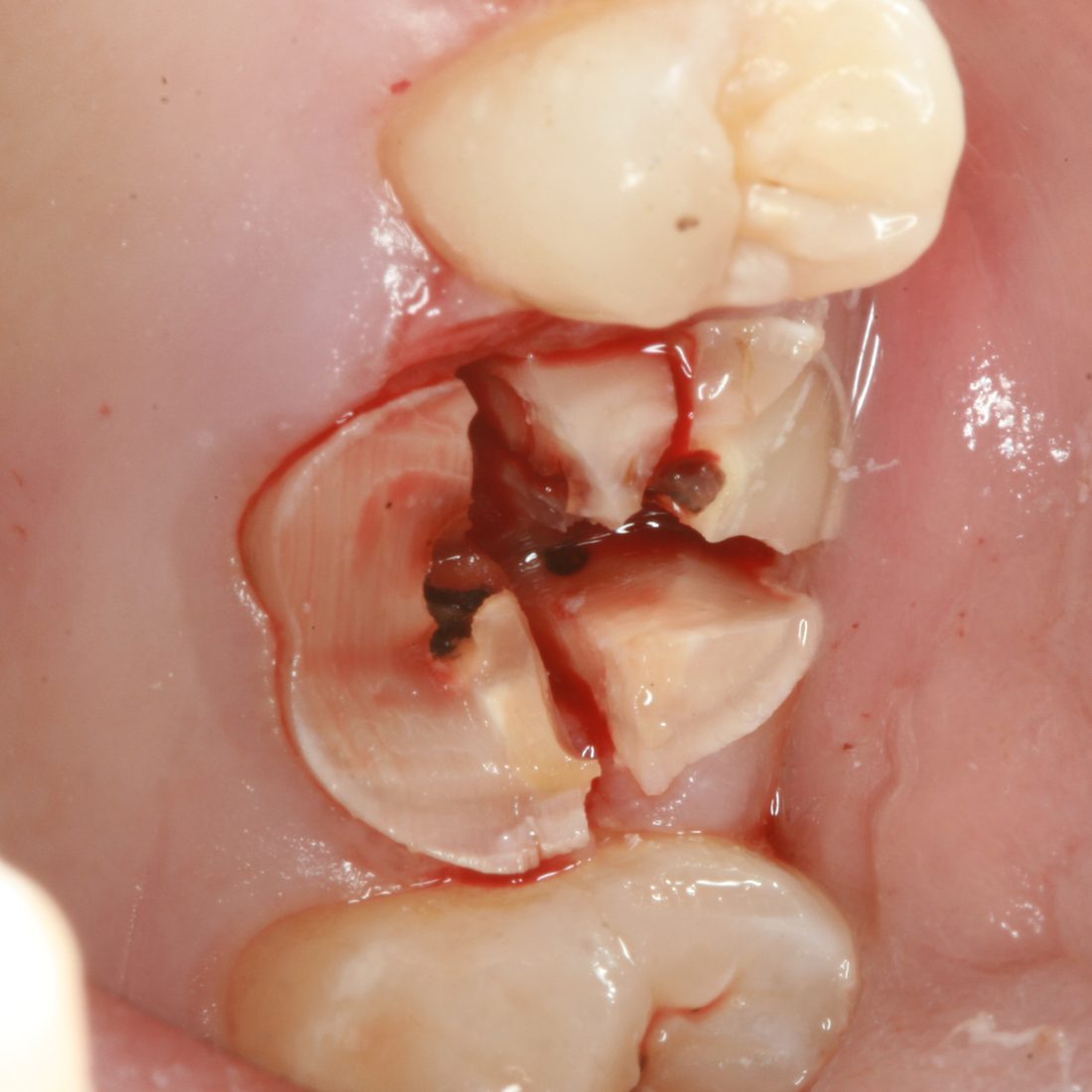 A molar sectioned in situ before the segments are retrieved